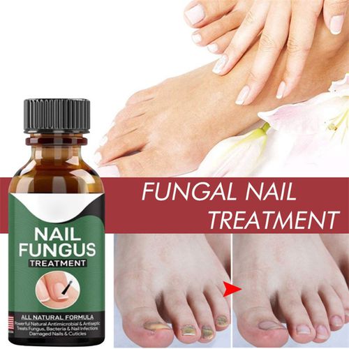 Fast Nail Fungal Treatments Nail Repair Essences Serum Care Treatments Foot Nail Fungus Removal Gel Paronychia Onychomycosis 1