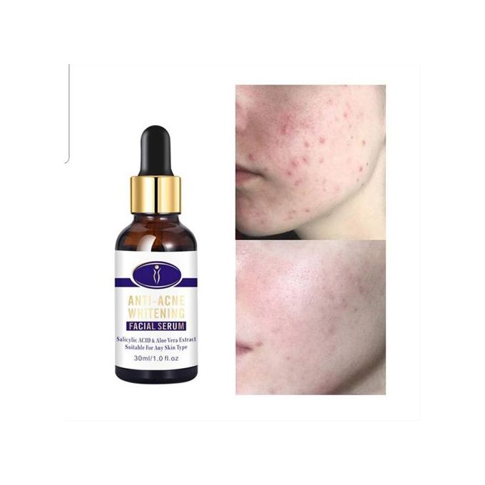 Aichun Beauty Medical Formula Anti-Acne Whitening Facial Serum-30ML