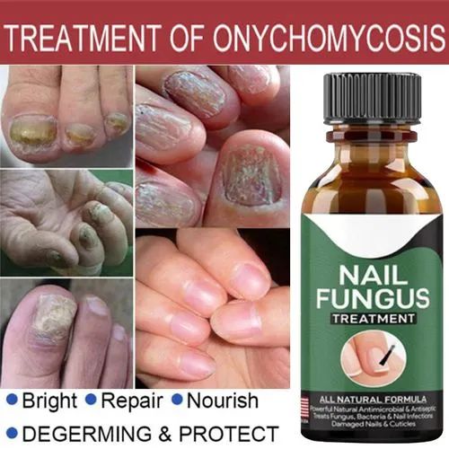 Fast Nail Fungus Treatment Gel – Nail Repair Essence Serum for Healthy, Smooth & Strong Nails buy online in Pakistan