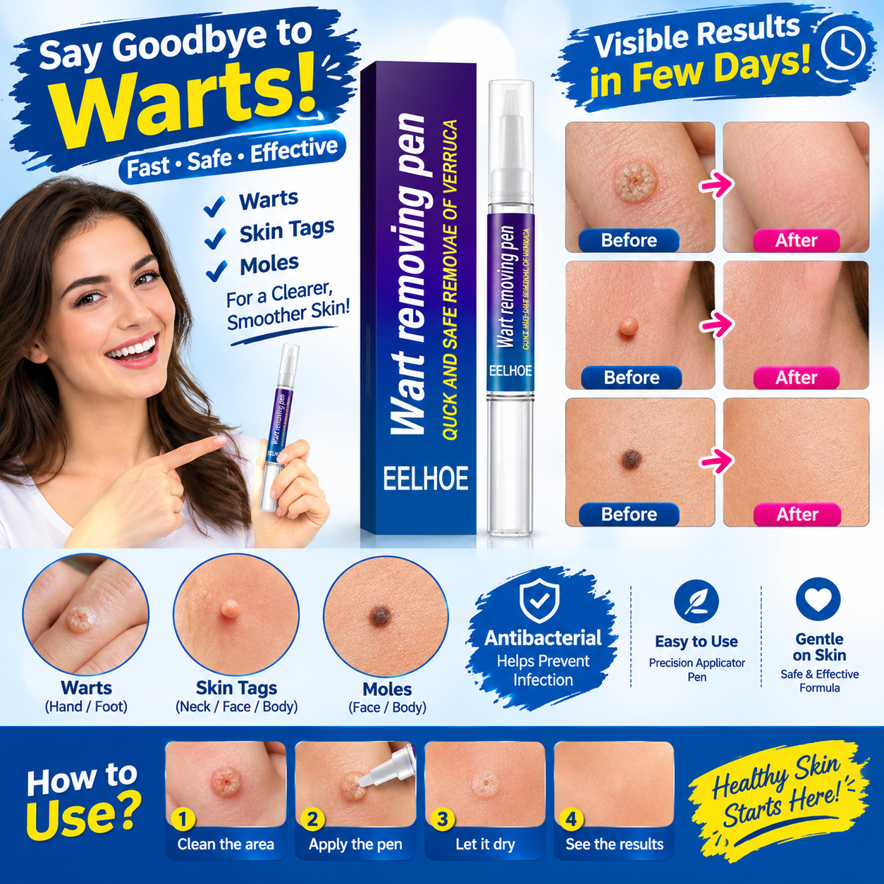 Wart Remover Gel Pen – Powerful Wart Removal Treatment for Hands, Feet & Skin | Wart Care Ointment for Common Warts | Easy Apply Skin Treatment view 3