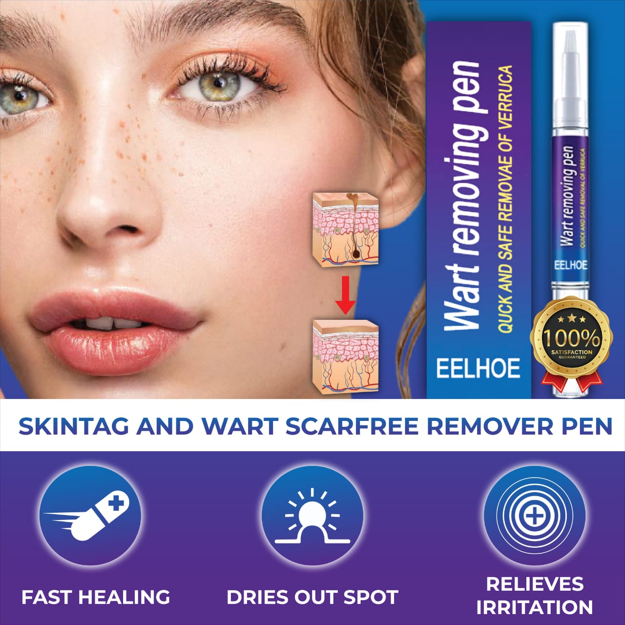 Wart Remover Gel Pen – Powerful Wart Removal Treatment for Hands, Feet & Skin | Wart Care Ointment for Common Warts | Easy Apply Skin Treatment view 4